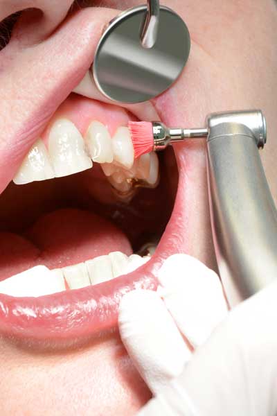 Polieren der Zähne nach gründlicher Reinigung [©K. U. Häßler, fotolia.com]