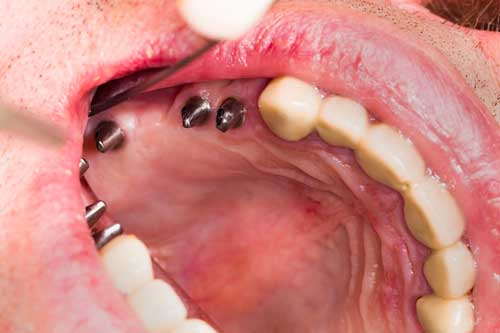 Zwei Freiendsituationen im Unter- und Oberkiefer, jeweils 3 Implantate zur Befestigung des künftigen Zahnersatzes [©Sandor Kacso, fotolia.com]