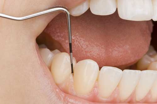 Sondieren der Zahnfleischtaschen [©Christoph Hähnel fotolia.com]